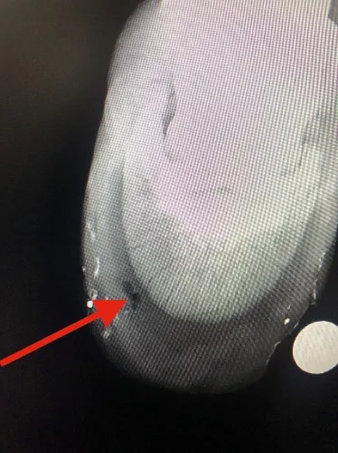 Abscess On Hoof Wall | GEM Equine Ltd